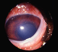 olho com glaucoma