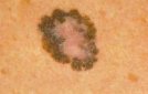 melanoma