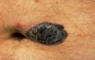 melanoma